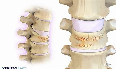 a-percutaneous-is-performed-to-treat-osteoporosis-related-compression-fractures.
